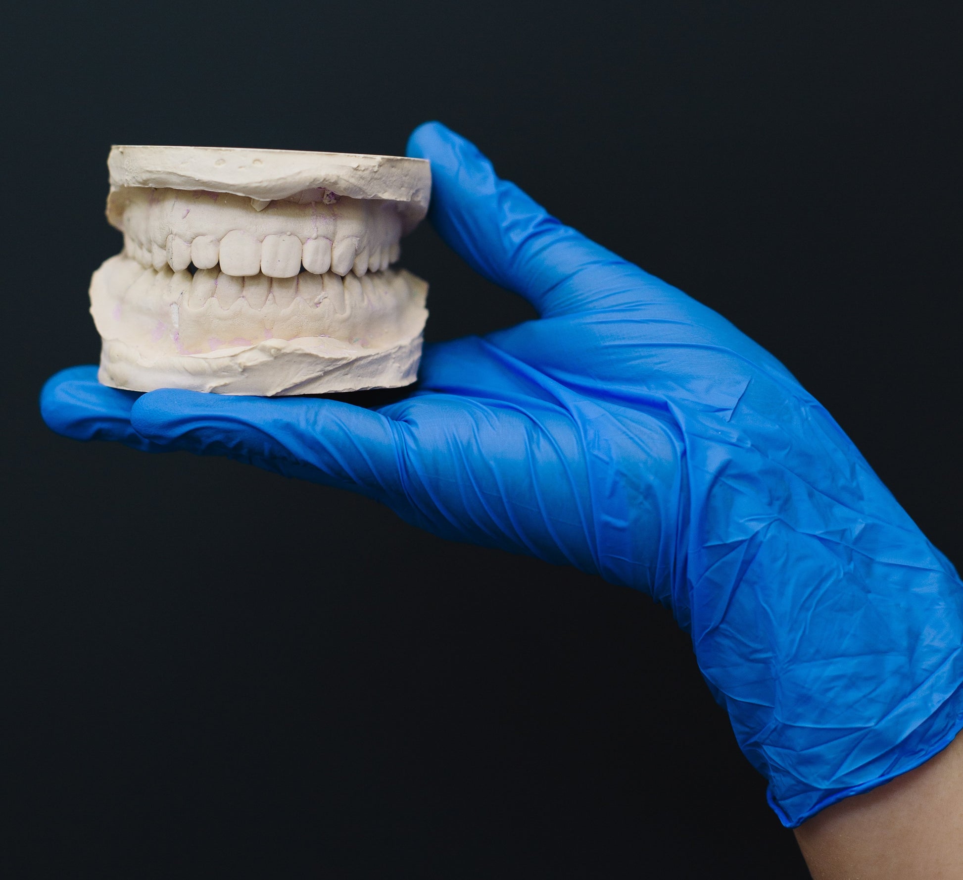 Dentist hand holding set of teeth modeled using USG plaster